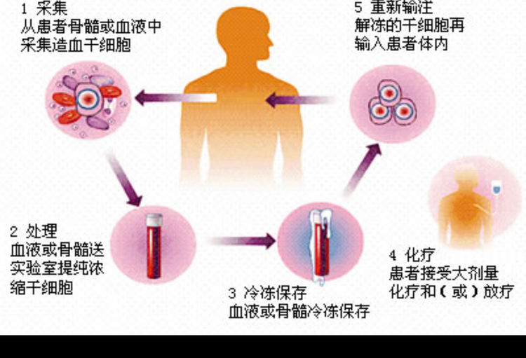 艾滋病治愈_艾滋功能性治愈_2030年艾滋治愈