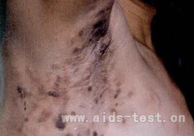 艾滋病症状初期_艾滋初期皮肤症状图片_艾滋病初期