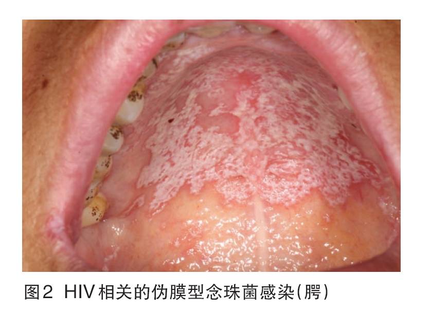 艾滋病感染初期症状图片_艾滋病初期_艾滋初期皮肤症状图片
