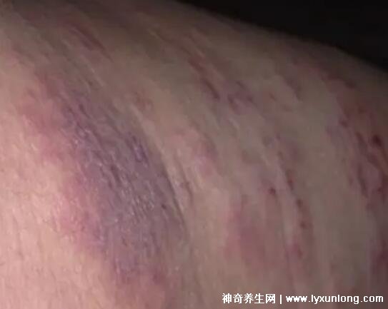 艾滋病感染初期症状_艾滋病初期_艾滋病感染初期症状图片