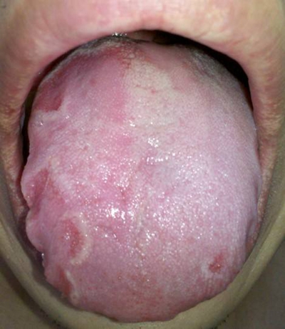 艾滋病初期的几种症状,艾滋病初期舌头症状