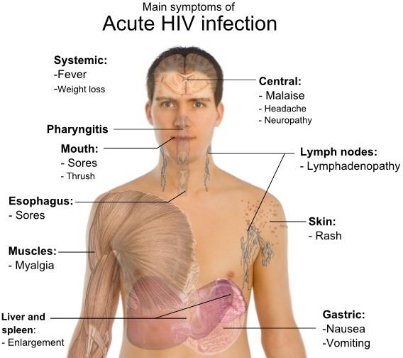 急性艾滋病的初期症状_艾滋病急性期_乙肝和艾滋那个病可怕