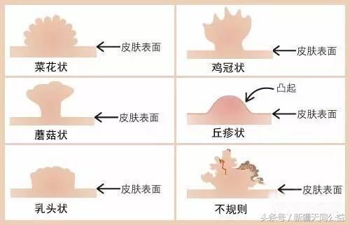 病人术后感染艾滋_艾滋病人自述_吸毒感染艾滋病的自述