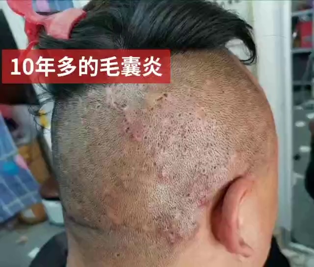 龙鱼艾滋与水泡病区别_艾滋病急性期_乙肝和艾滋那个病可怕