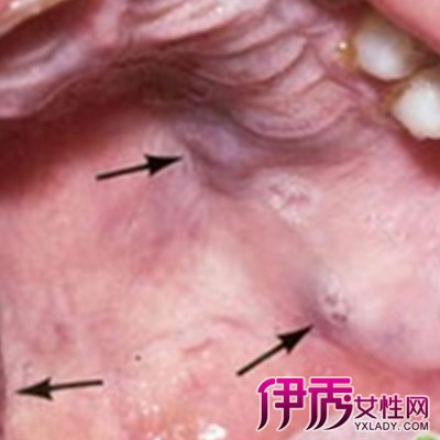 艾滋病患者初期口腔图图片