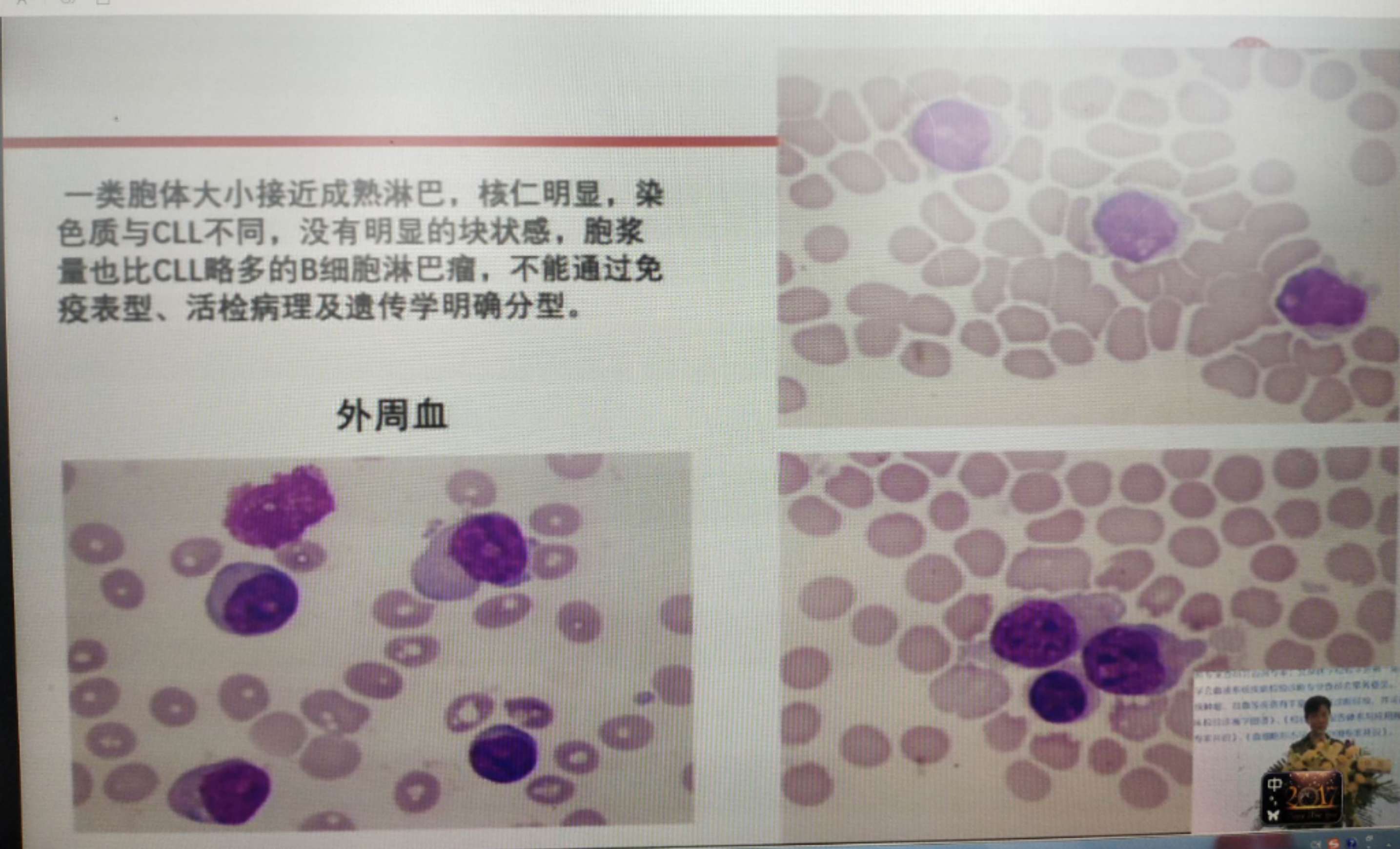 修脚出血了,会感染艾滋和其她病吗_艾滋病急性期_艾滋急性