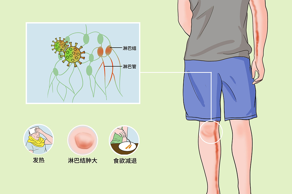 艾滋病感染初期症状_人工寻麻疹是艾滋病的初期症状吗_艾滋病初期