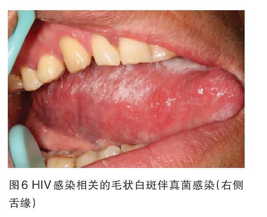 艾滋治愈研究_治愈艾滋病_西班牙功能性治愈艾滋