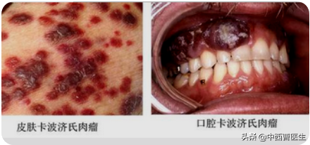 口腔粘膜病破损艾滋_艾滋病急性期_急性化脓扁桃体 艾滋