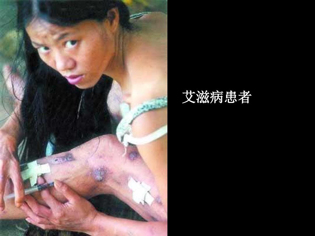 艾滋病人初期症状自述 早期症状容易被忽视更新时间:2017