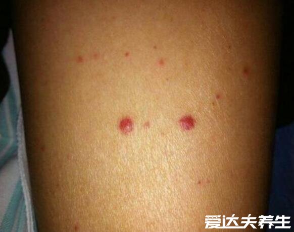 【艾滋病皮肤症状图片】艾滋病初期小红点照片