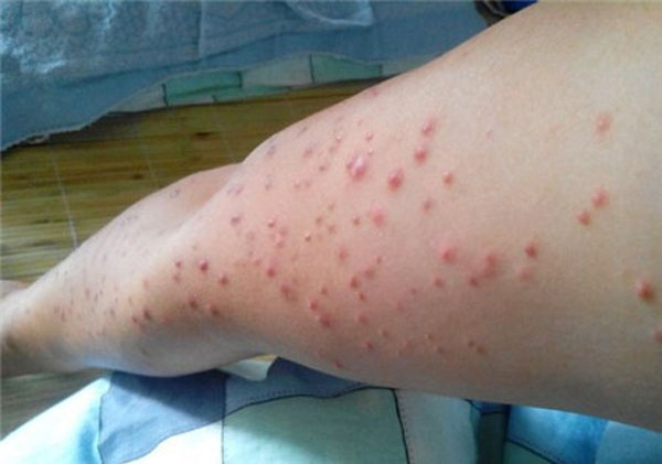 hiv感染初期症状皮肤图片