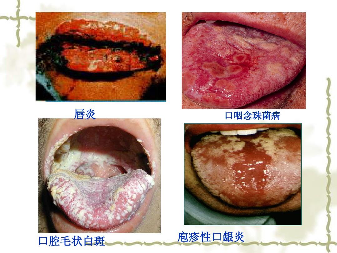 艾滋病初期_艾滋病感染初期症状图片_艾滋病感染一般初期会有什么症状