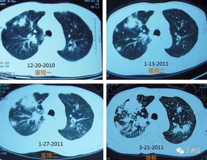 下列哪项是艾滋病的哨点监测期_艾滋病急性期_艾滋急性期会全身瘙痒吗