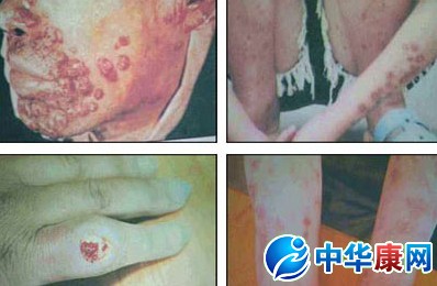 急性胃扩张病人可发生_艾滋病急性期_口腔粘膜病破损艾滋