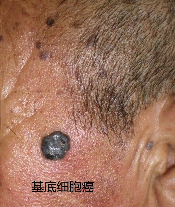 治愈艾滋病_ub421可以治愈艾滋吗_艾滋何时治愈