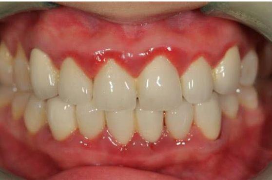 出现牙龈线形红斑,意味着感染了艾滋病?