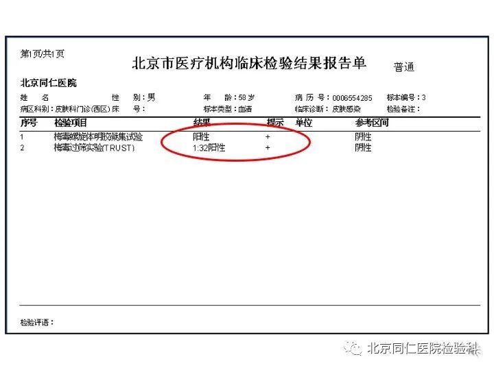 急性艾滋病的初期症状_艾滋病急性期_急性艾滋病感染必有症状