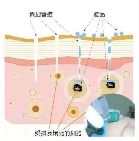 艾滋有急性咽喉炎症状吗_艾滋病急性期_艾滋急性