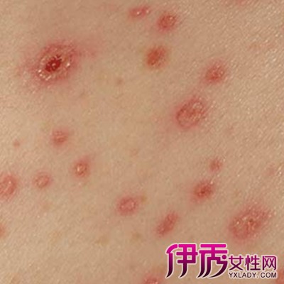 hiv边缘行为恐艾脱恐_恐艾最权威的脱恐方法_恐艾