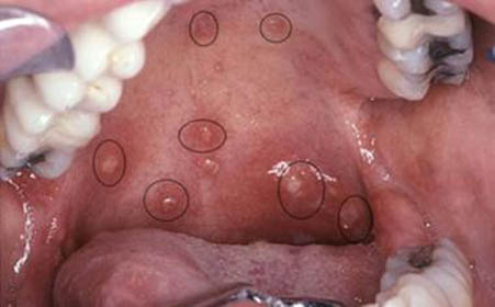 早期艾滋病口腔水泡图片