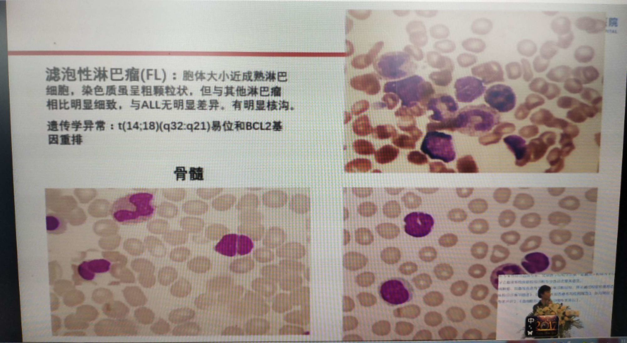 修脚出血了,会感染艾滋和其她病吗_乙肝和艾滋那个病可怕_艾滋病急性期