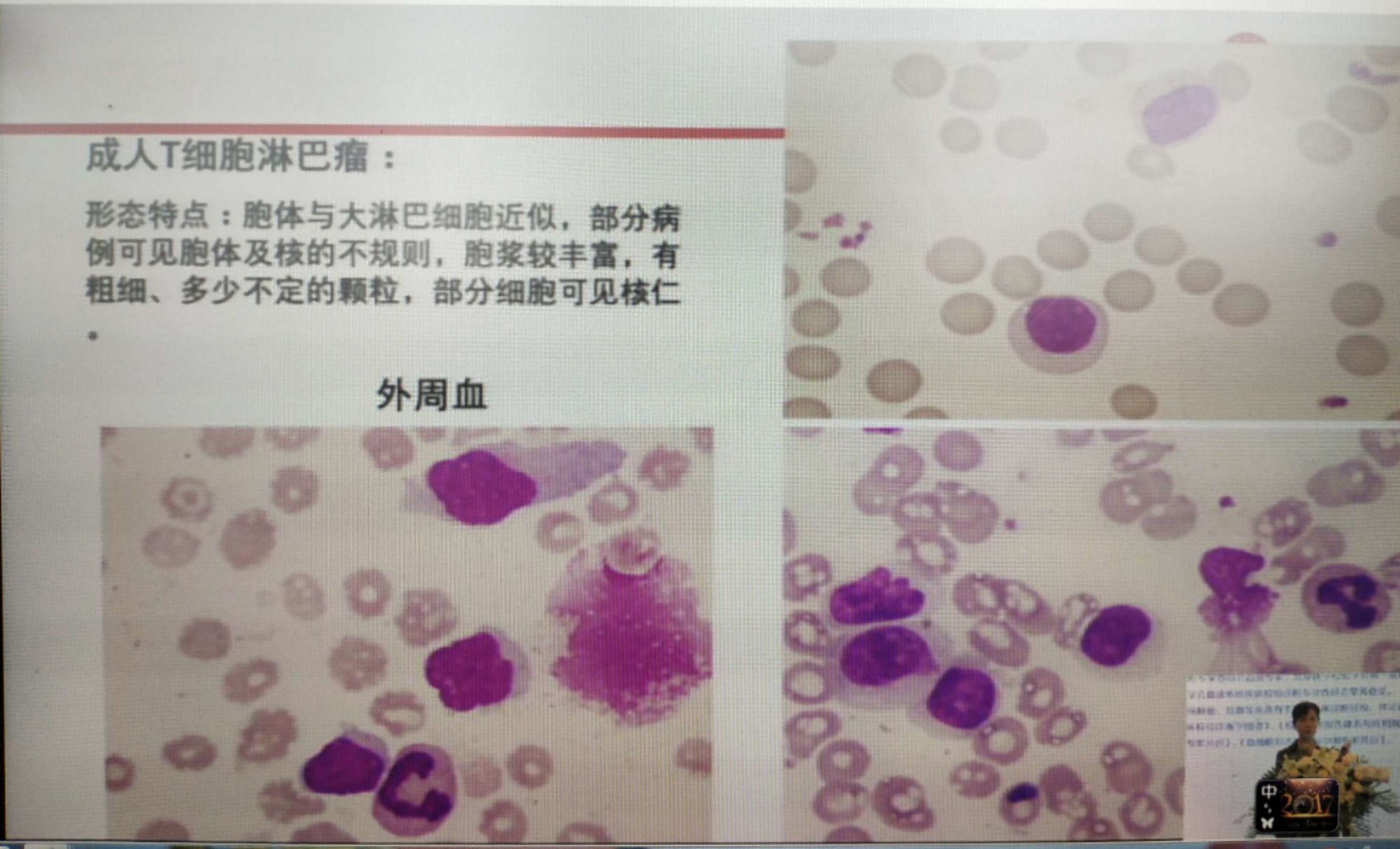 乙肝和艾滋那个病可怕_艾滋病急性期_修脚出血了,会感染艾滋和其她病吗