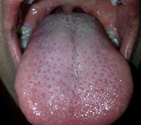 艾滋病窗口期舌头症状