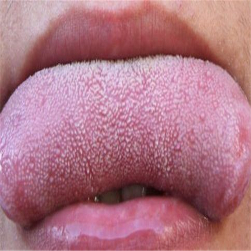 舌头有黑点是不是艾滋病