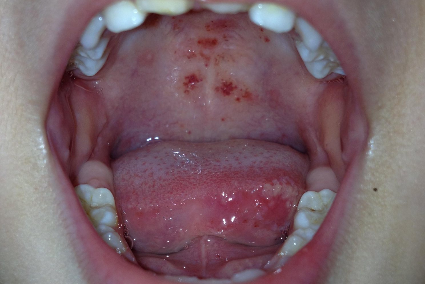 hiv口腔症状图片