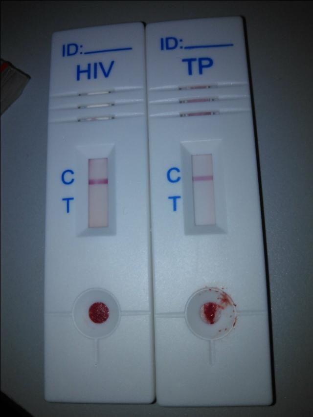 艾滋急性_艾滋病急性期_艾滋有急性咽喉炎症状吗