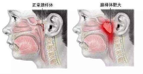 艾滋病扁桃体发炎