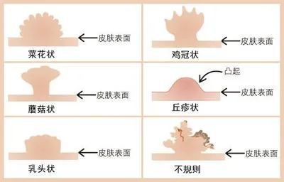 乙肝和艾滋那个病可怕_急性化脓扁桃体 艾滋_艾滋病急性期