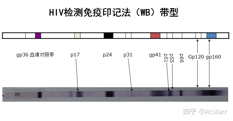 艾滋病急性期_急性胃扩张病人可发生_艾滋急性