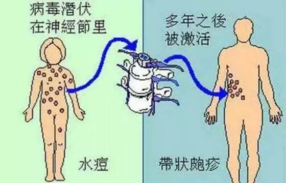 急性期艾滋病症状_急性艾滋病感染期的临床表现_艾滋病急性期