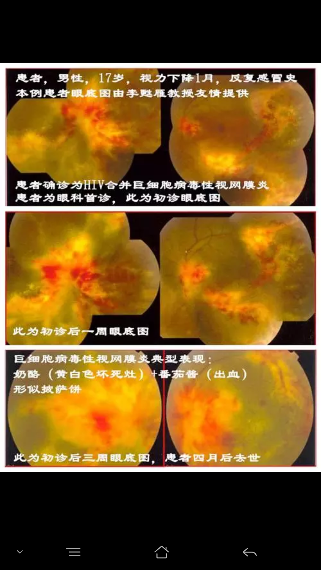 治愈艾滋病有希望吗_治愈艾滋病_治愈的艾滋病