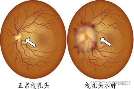 急性艾滋病感染期的主要表现_艾滋病急性期_急性期艾滋病症状