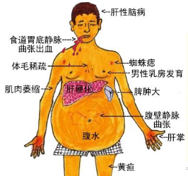 初期艾滋病患者症状_初期艾滋病能活多久_艾滋病初期