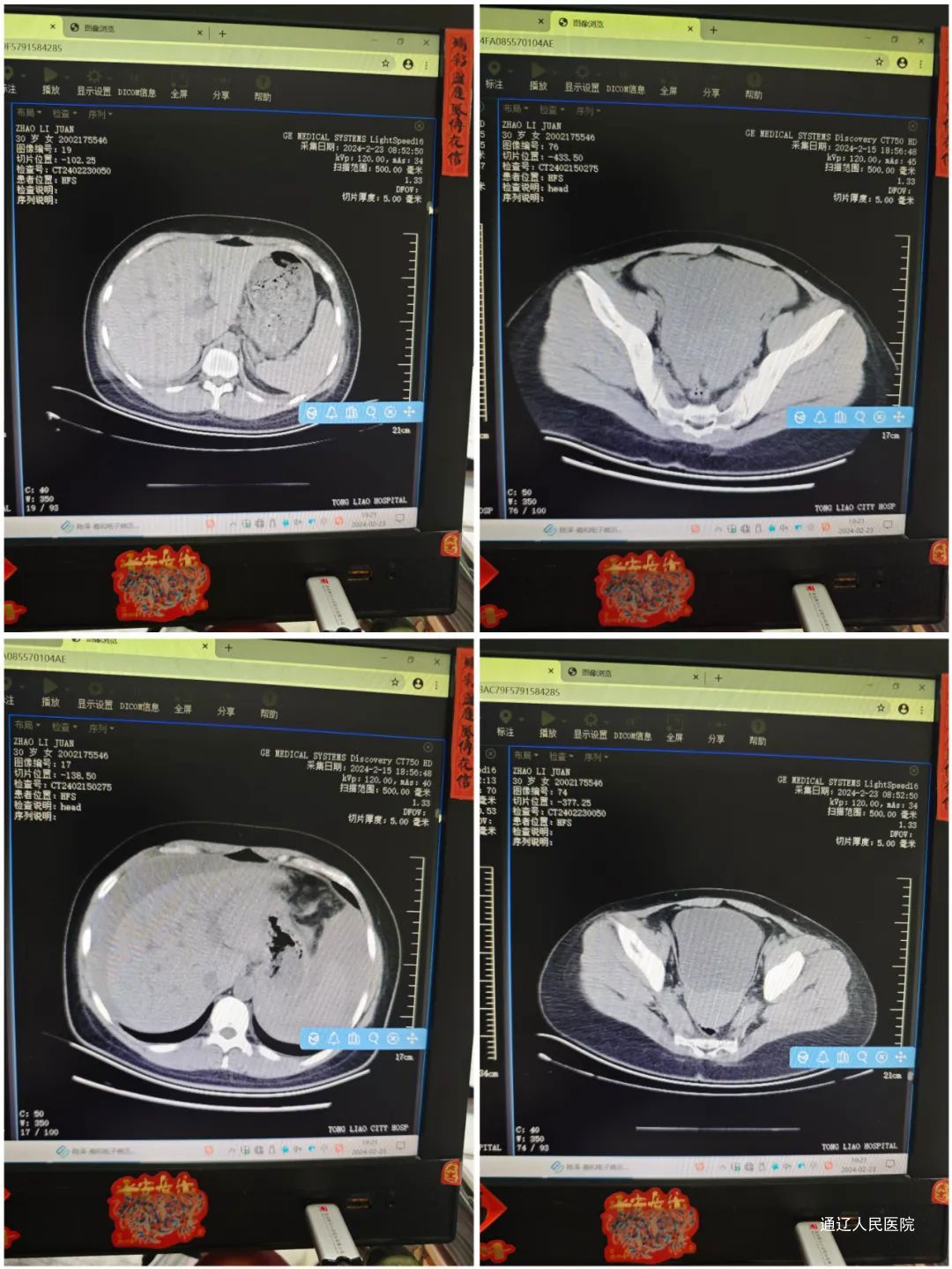 治愈艾滋病的又一人_治愈艾滋病有希望吗_艾滋病治愈