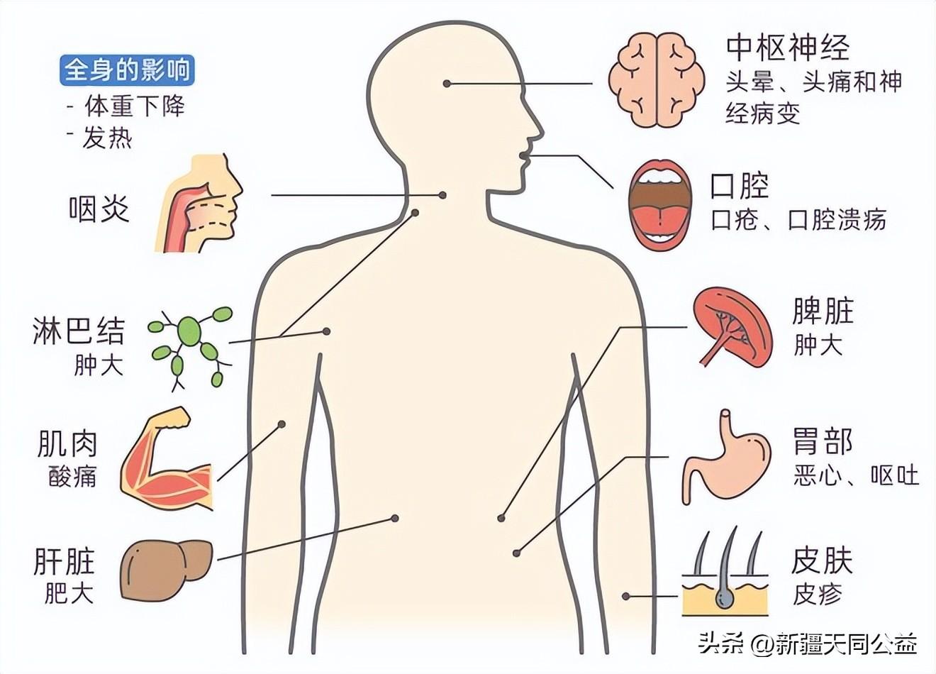 治愈艾滋病有希望吗_治愈艾滋病的又一人_治愈艾滋病