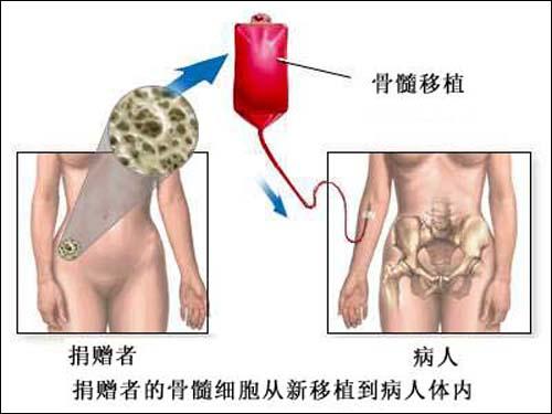 治愈的艾滋病人_治愈艾滋病有希望吗_艾滋病治愈