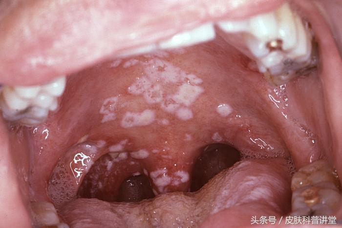 急性艾滋病感染期的临床表现_艾滋病急性期_急性期艾滋病患者自述症状