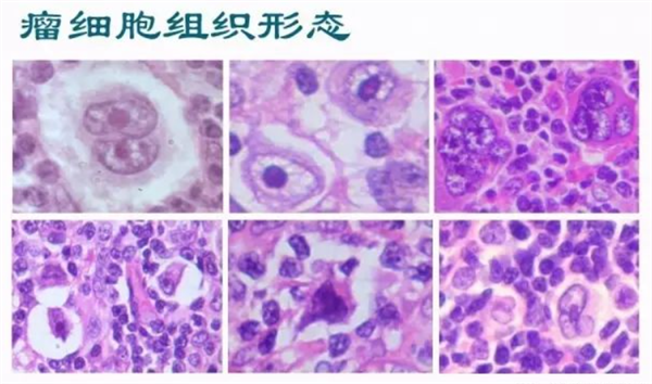 全球第5位艾滋病治愈者出现：真的可以根治了？