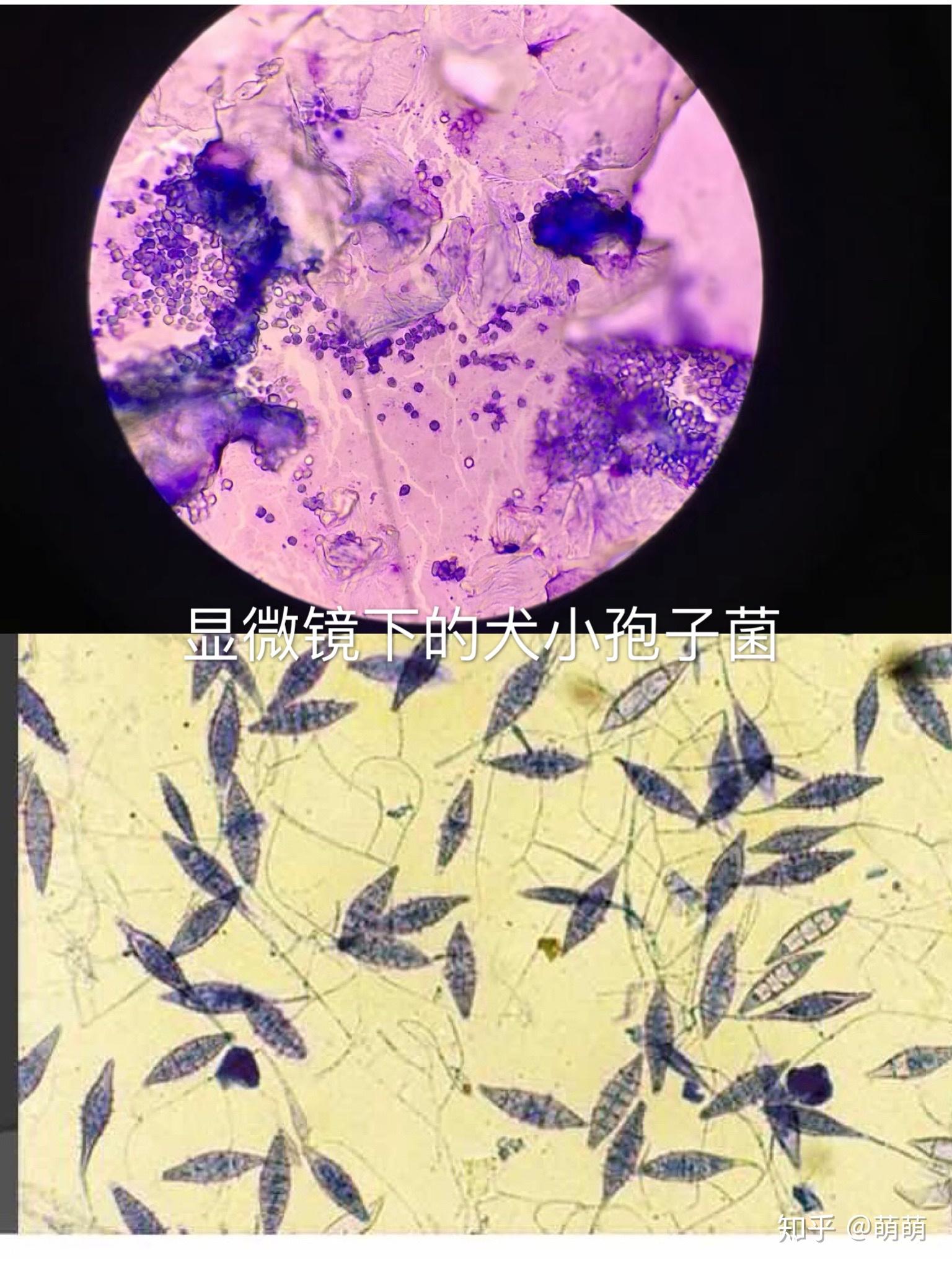 急性期艾滋病症状_艾滋病急性期_急性期艾滋病患者自述症状